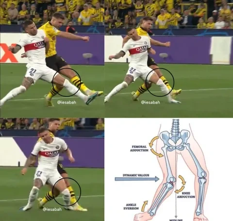 مكان إصابة لوكاس هيرنانديز أمام بوروسيا دورتموند (X: iesabah)